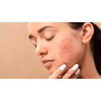 Gentle and Effective: Best Cleansers for Fungal Acne Treatment