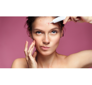 Combate à acne fúngica: o poder do ácido salicílico no tratamento