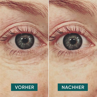 APRICOT wiederv Anti-Falt-Augen Pads Hyalur