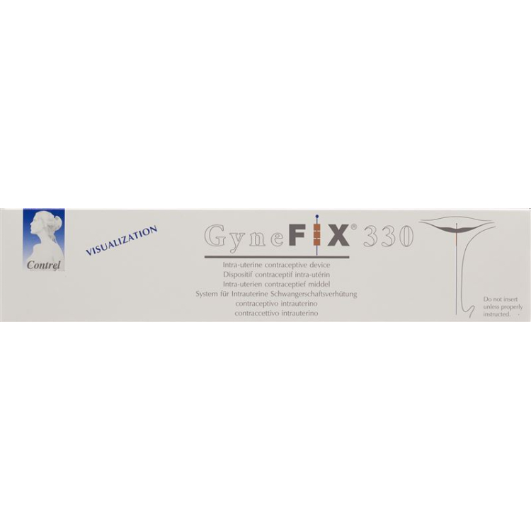 GyneFix 330 IUD