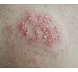 Genital herpes