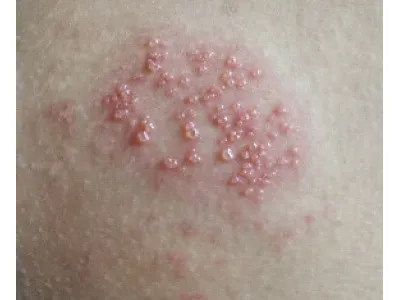 Genitalni herpes