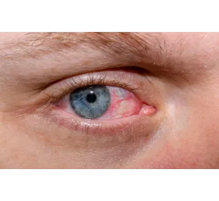 EvoTears OMEGA – Best Eye Drops for Dry Eyes and Meibomian Gland Dysfunction